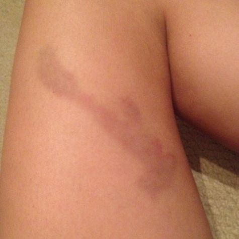 Senior Bailey Bitetto's mysterious bruise. All she knows is it kind of looks like Italy. 