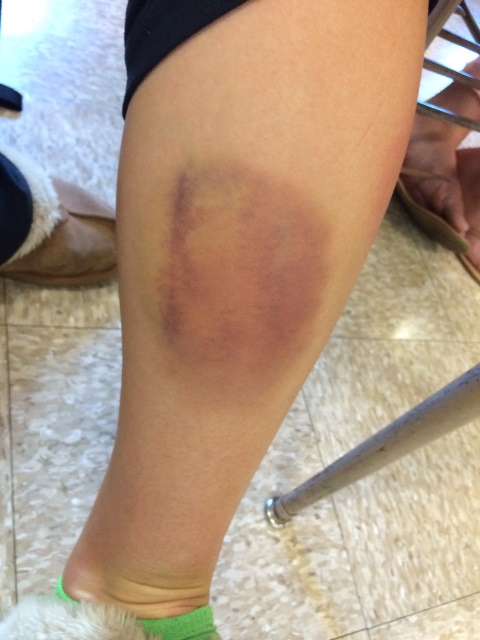 Varsity field hockey player, Rebecca Rakowitzs bruise 